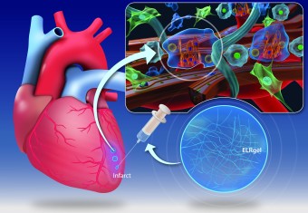 an image of a heart having a Myocardial infarction or heart disease with a hydrogel being injected into it