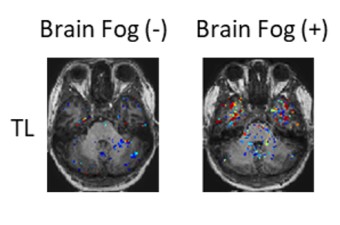 2 MRI Images of a brain, the first image you can't see any signs of brain fog and in the second image you can.